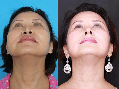 鼻頭縮小手術(shù)恢復(fù)時間要多長呢？