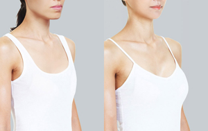 豐胸費(fèi)用大概需要多少？