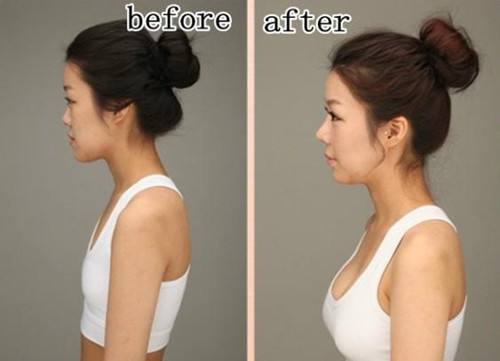 假體隆胸價格是多少？