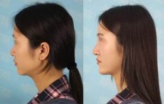 隆鼻后修復(fù)手術(shù)恢復(fù)時(shí)間會(huì)更長嗎？