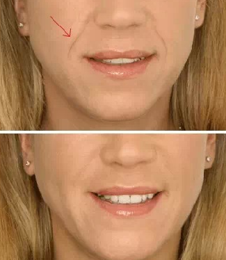 去法令紋有什么好辦法？