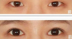 上眼瞼下垂怎么辦？