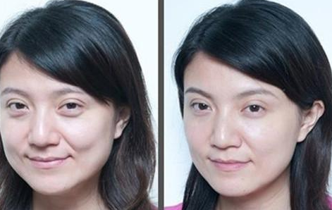 上眼瞼下垂怎么辦？