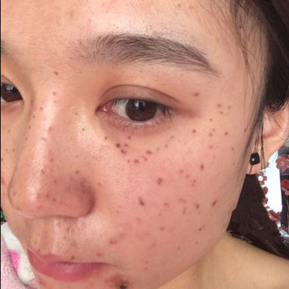 激光祛斑的費(fèi)用是多少？