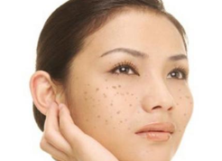 激光怎樣祛斑？這些后果你都知道嗎？