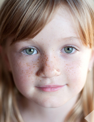 如何去臉上的斑比較有效?