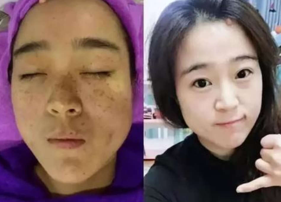 激光祛斑有效嗎？