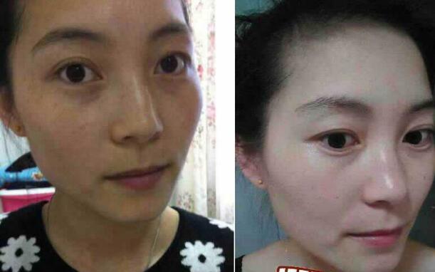 激光祛斑有效嗎？