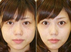 激光怎么去斑？