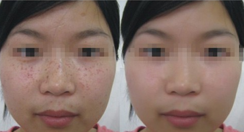 快速祛斑的方法有哪些？