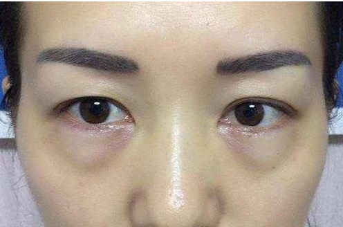 快速去除眼袋后有什么注意事項(xiàng)？