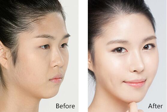 昆明隆鼻修復(fù)手術(shù)一般價(jià)格是多少呢?