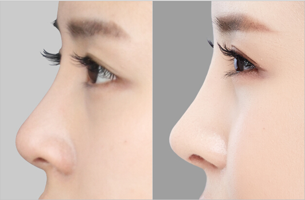 整形隆鼻術(shù)前有什么需要注意的？