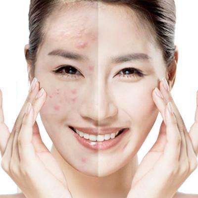 激光去痘后怎么護(hù)理？