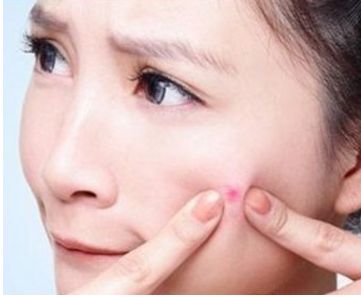 下巴上長痘痘是什么原因？怎么去除？