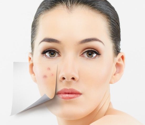 臉上長(zhǎng)痘怎么辦？