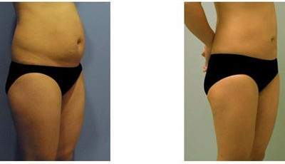 腹部吸脂術(shù)影響身體健康嗎？