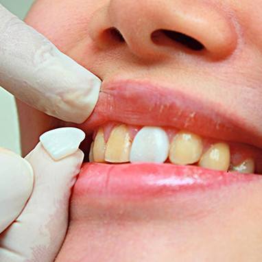 烤瓷牙價(jià)格是多少？