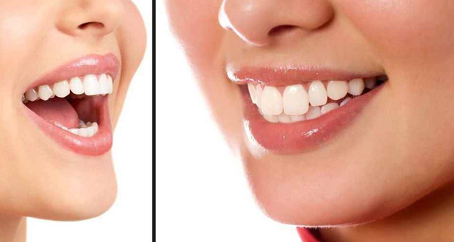 烤瓷牙價(jià)格是多少？