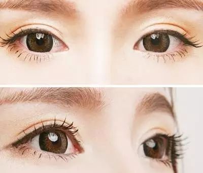 雙眼皮埋線多少錢？