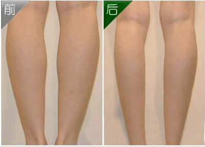 抽脂瘦腿多少錢？