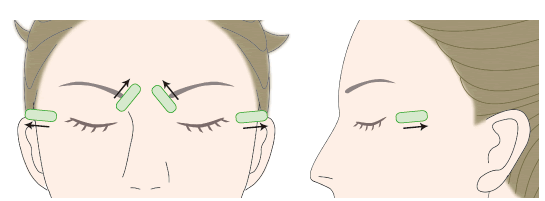 眼睛周?chē)邪毯勰茏雎窬€(xiàn)雙眼皮嗎