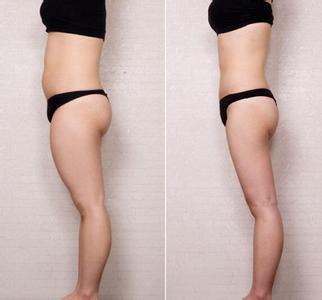 腿部抽脂會反彈嗎？