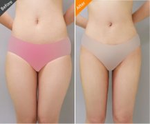 腿部抽脂會反彈嗎？