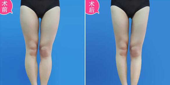 吸脂價格是多少？