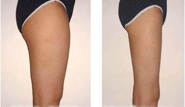 吸脂價格是多少？