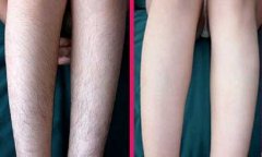 小腿激光脫毛后怎么護(hù)理？