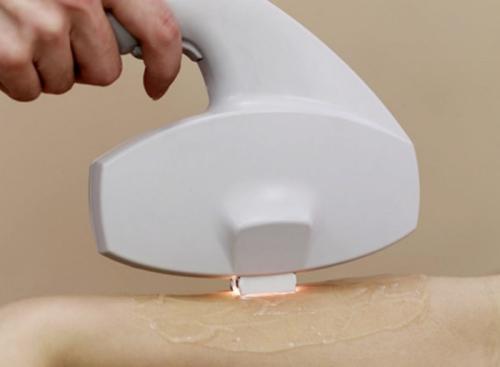 激光脫毛效果好嗎？