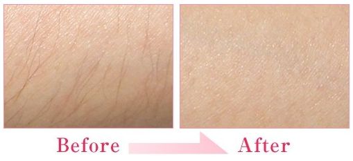 激光脫毛效果好嗎？