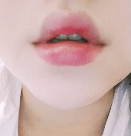 用玻尿酸豐唇后怎么護理？