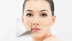 如何快速去除痘??？