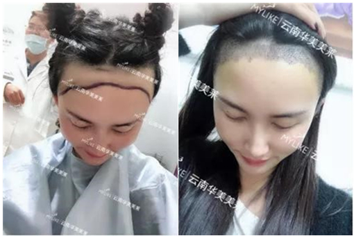 科技，讓植發(fā)更簡(jiǎn)單丨美萊ARTAS機(jī)器人植發(fā)優(yōu)勢(shì)