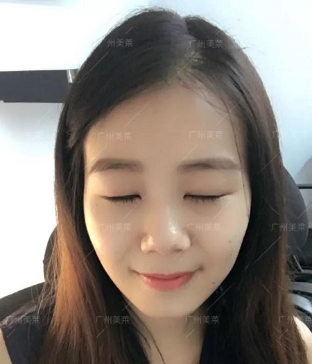 割雙眼皮，還開(kāi)了眼角...