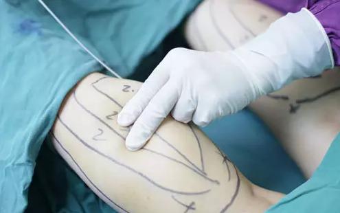 用吸脂手術(shù)來(lái)瘦腿會(huì)有怎樣的效果