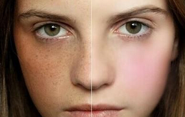 武漢激光祛黃褐斑安全嗎？