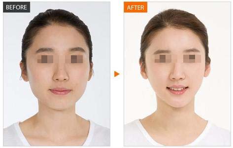 天津瘦臉的效果能不能維持一年?