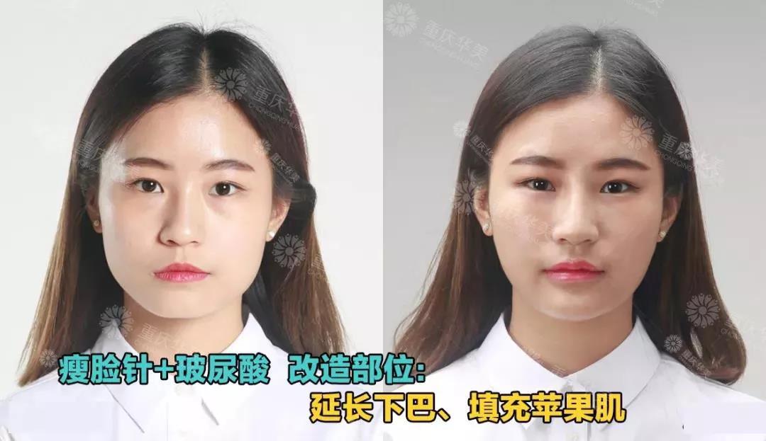 玻尿酸+瘦臉針，柔美面部線條，打造先進(jìn)小V臉