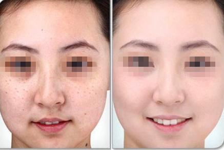 武漢激光祛斑的一般需要多少錢？