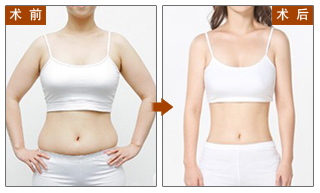 深圳做腹部抽脂減肥手術(shù)安全嗎？