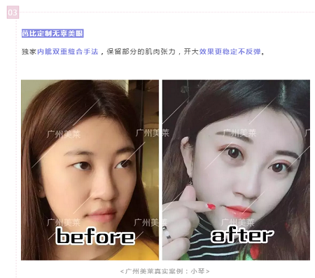 腫眼泡？重內(nèi)眥？