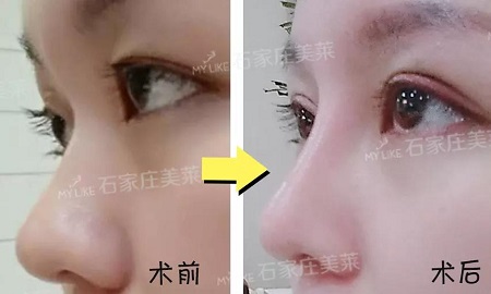 術(shù)后半個(gè)月Get專業(yè)混血臉！可萌可酷美翻了~