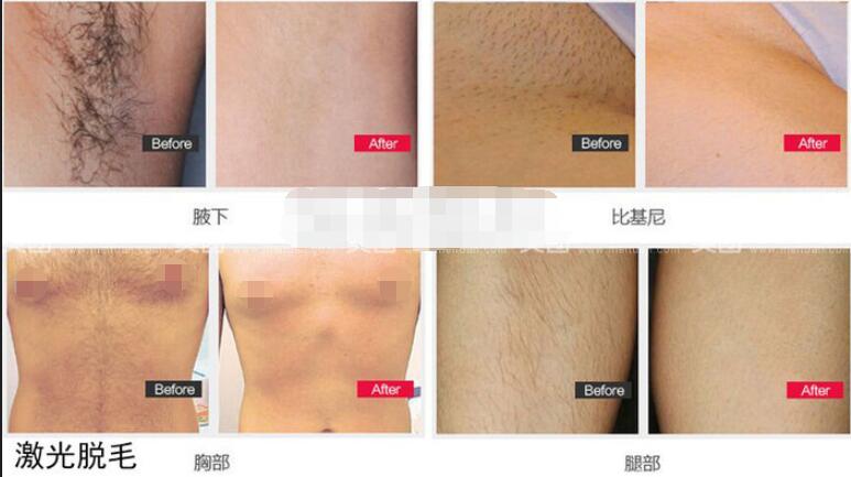 深圳激光全身脫毛一般多少錢？