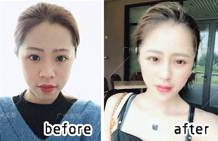 3年隆鼻案例回顧！