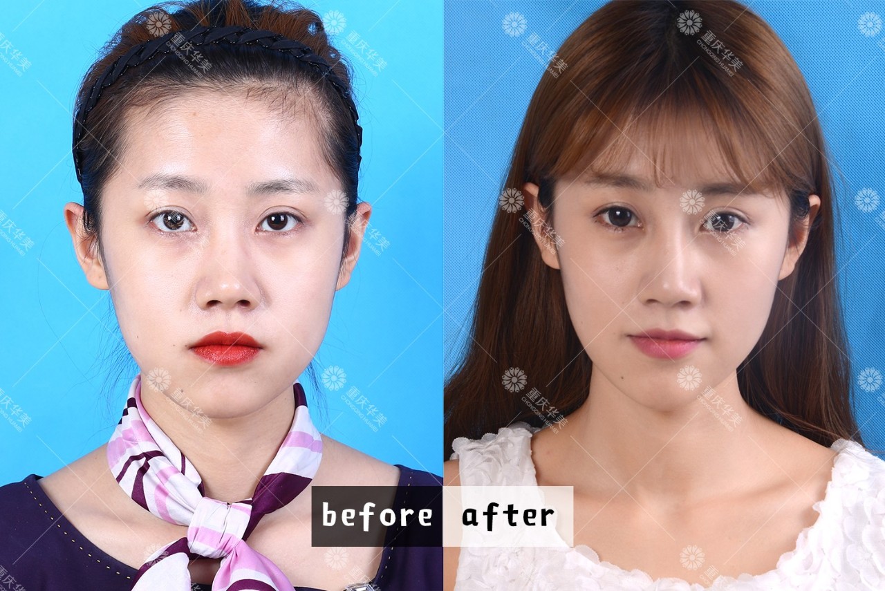 2分鐘看懂進(jìn)口和國(guó)產(chǎn)瘦臉針，有什么區(qū)別？