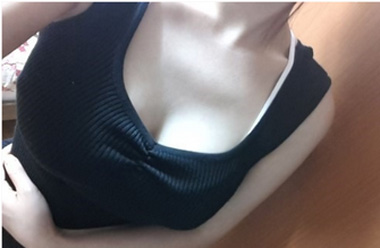 武漢豐胸整形手術(shù)貴嗎？