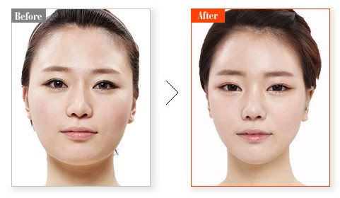 寧波瘦臉一般多少錢？